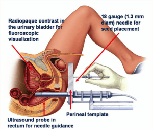 Prostate Rub